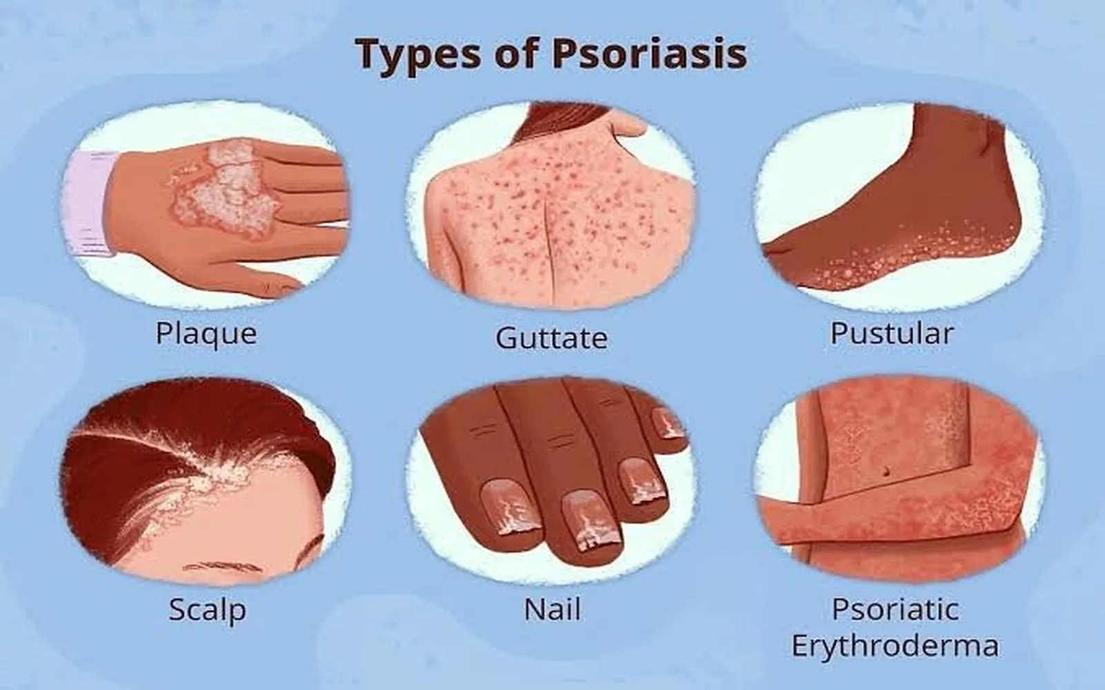 Exploring Effective Psoriasis Therapies: Insights on What’s Effective and What’s Not