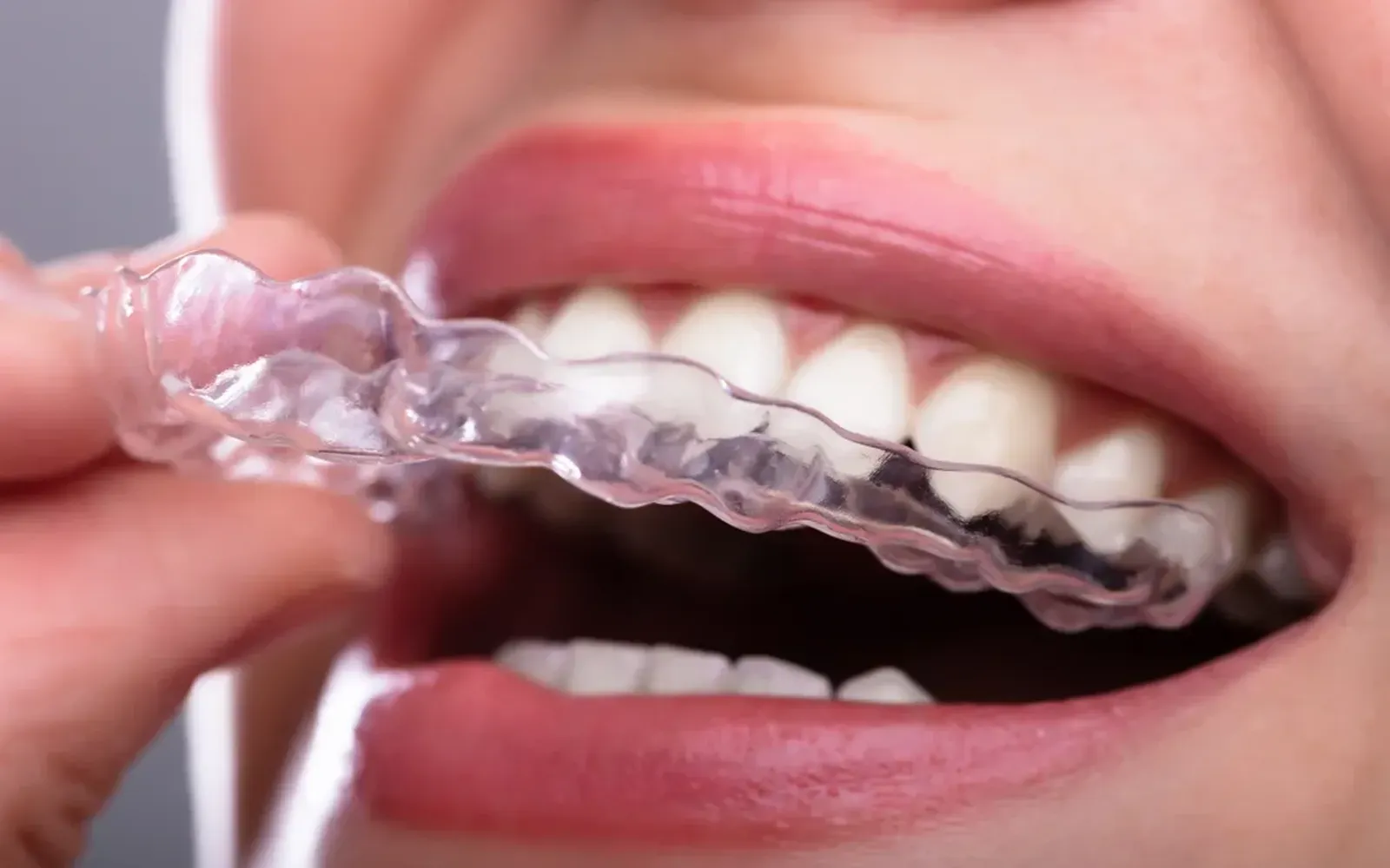 Discover Top Clear Aligners in Your Area: The Ultimate Guide for a Confident Smile