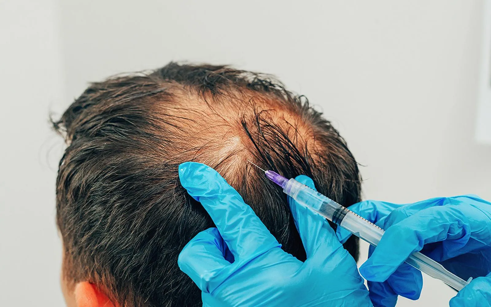 Effective Solutions for Hair Restoration: Exploring Your Treatment Choices