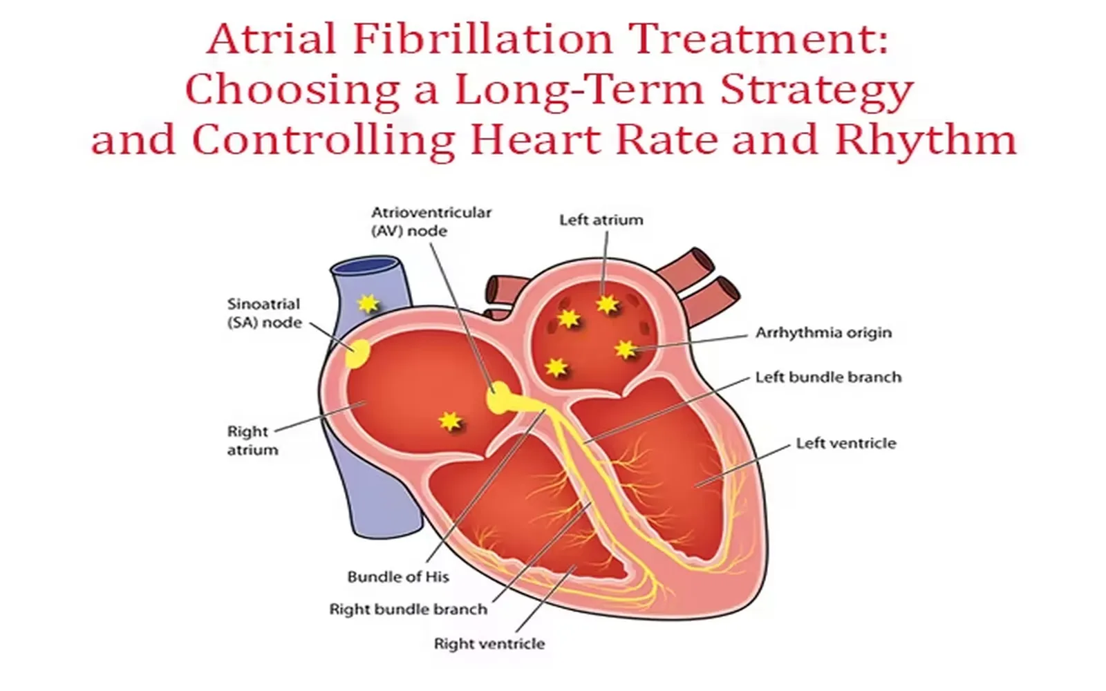 Exploring Heart Arrhythmias: Key Triggers and Effective Treatment Strategies